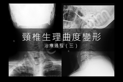 頸椎生理曲度變形治療記錄（三）