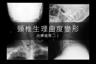 頸椎生理曲度變形治療記錄（二）